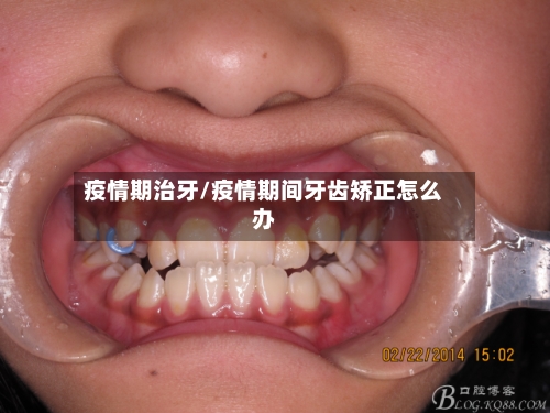 疫情期治牙/疫情期间牙齿矫正怎么办